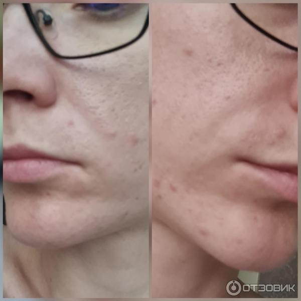 Коррекция морщин носогубных складок Juvederm Ultra 4 фото