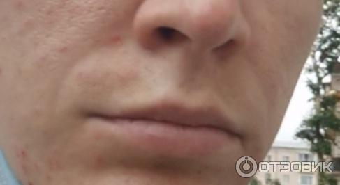 Коррекция морщин носогубных складок Juvederm Ultra 4 фото