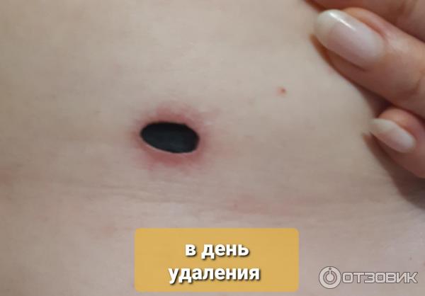 Как ухаживать за раной после лазерного удаления?