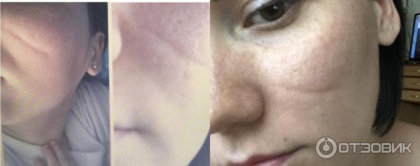 Набор для коррекции растяжек Ферменкол фото