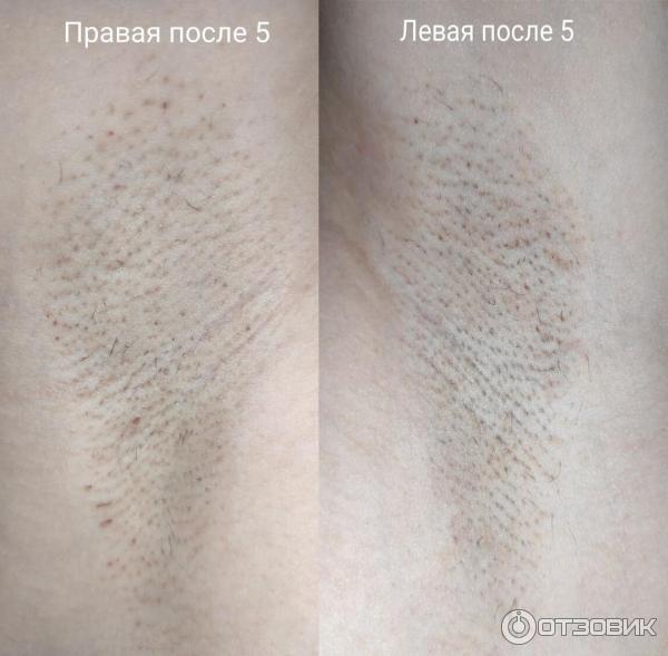 Отзыв о Электроэпиляция | Долго и больно.