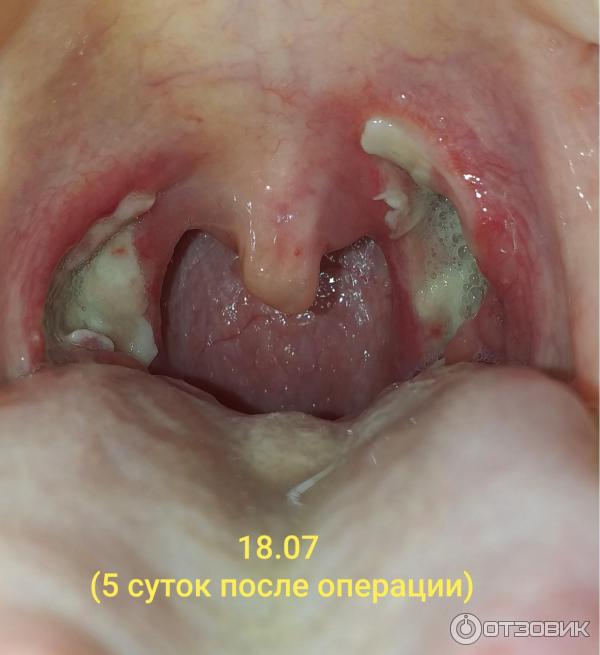 Тонзиллэктомия или удаление миндалин фото