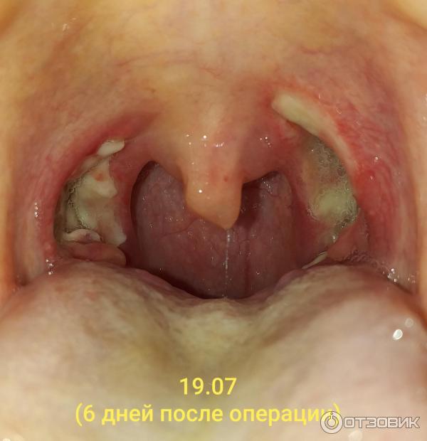 Тонзиллэктомия или удаление миндалин фото