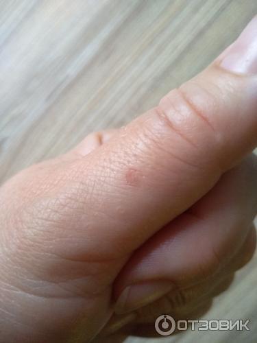 Лечение через 3 дня