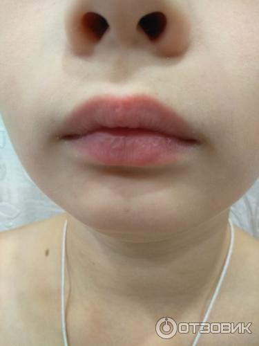 Лечение мазью Стелланин фото